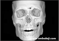 CT image showing fracture of the frontal sinus wall and orbital rim of forehead bone