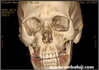 CT scan image showing fractured site