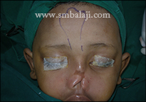 During surgery, forehead flap region marked