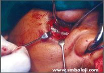 Eye socket floor reconstructed with bone plate