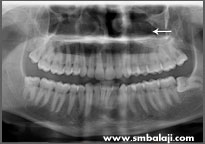 Facial Fracture Balaji Dental