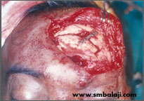 Fixation of the frontal sinus wall using bone plate