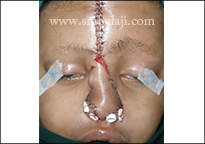 Forehead flap used for nose reconstruction