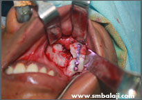 Fractured segments fixed with bone plate