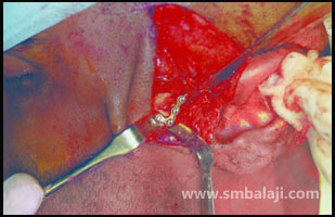 Jaw joint (TMJ) fracture fixed with L plate