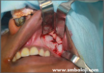 Open reduction of fracture