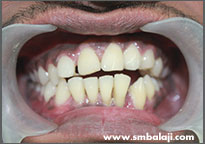 Postoperative view of well stabilised  teeth