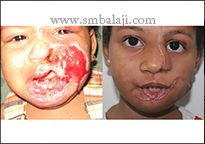 The child suffered severe burns of the left side of her face; the child after reconstructive surgery