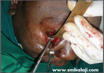 During surgery-eye socket reconstruction using titanium mesh