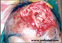 Fracture of the frontal sinus wall treated by fixing bone plate