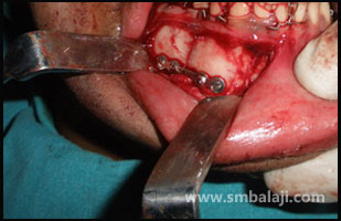 Right side lower jaw fracture reduced and fixed with miniplate