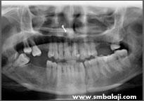 X-ray showing multiple fractures in the lower jaw bone