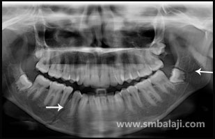 X-ray showing multiple fractures of lower jaw