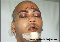 Fracture of the forehead bone with severe swelling around the eyes