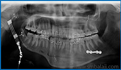 Bone segments moving apart to lengthen bone