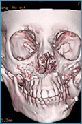 CT scan image showing asymmetry of facial skeleton