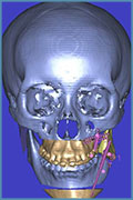 Distraction Osteogenesis treatment planning