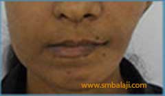 Face made more symmetrical after distraction osteogenesis