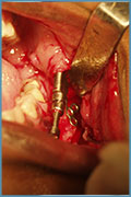 Fixing the intraoral distractor during surgery