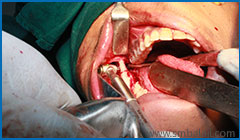 Jaw bone segmented on the left side and preparation to fix distractor device