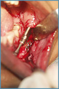 Placing the intraoral distractor