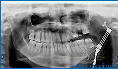 X-ray at the end of distraction treatment showing corrected asymmetry