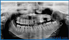 X-ray showing deficient growth of the lower jaw bone on left side