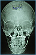 X-ray showing skeletal asymmetry of the face corrected after treatment