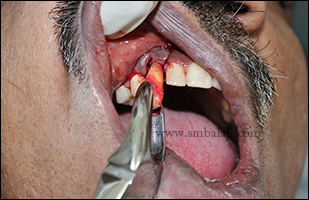 Fractured canine removed without any damage to the supporting tooth structures