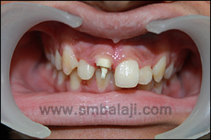 Fractured upper right central incisor due to failed prosthesis following endodontic treatment