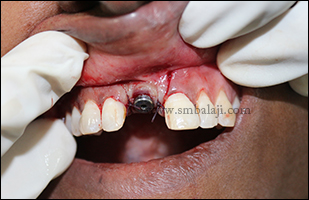 Implant fixed with good stability and retention