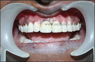 Naturally well blended fixed ceramic prosthesis loaded onto the implant