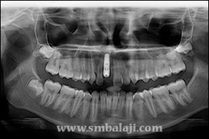 Postoperative x-ray showing successful implant placement