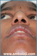 After surgery Nose Reconstruction