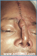 Placement of forehead flap