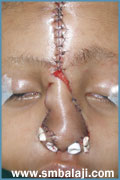 Forehead flap used for nose reconstruction