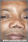 Nasal-defect-before-treatment