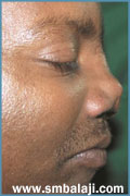 Nasal defect side view before treatment