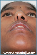 Nose deformity
