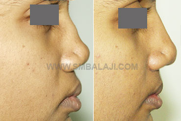 Nasal bridge augmentation surgery on a nose that has a depressed bridge with a sunken appearance
