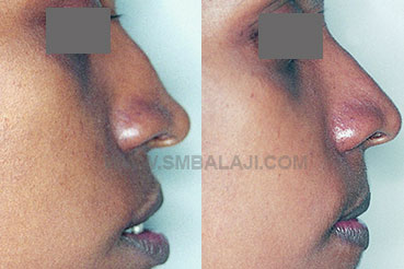 Nasal correction surgery of a nose