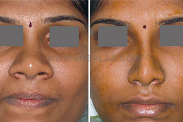Nose reduction surgery of a very broad nose