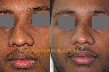 Surgical correction of a crooked nose that resulted from an accident Best rhinoplasty surgeon in India