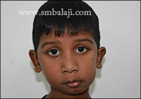 Facial asymmetry due to unilateral TMJ ankylosis