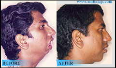 Lower jaw defect due to TMJ ankylosis