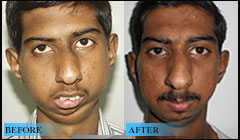 Severe mandible deformity due to TMJ ankylosis