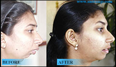 TMJ Jaw joint surgery