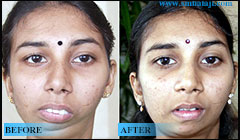 TMJ jaw joint surgery