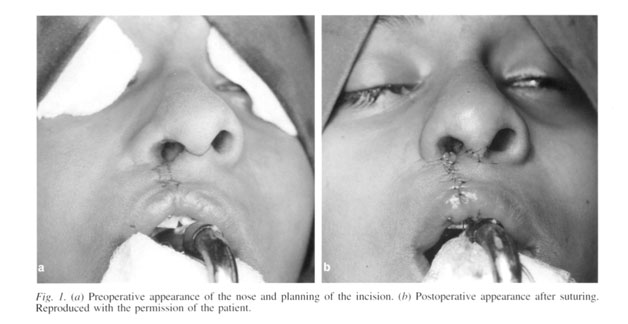 cleft lip and palate