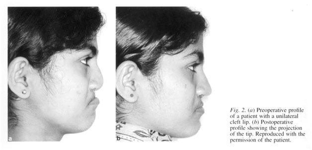 deformity associated with severe unilateral cleft lip